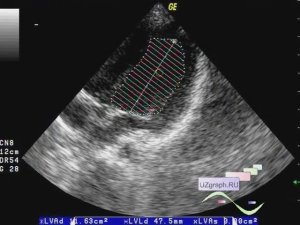 Мини-Лекция: ЭхоКГ - Базовый Уровень плюс. Измерение Фракции выброса по Симпсону