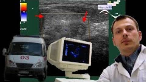 Детское УЗИ брюшной полости - Аппендикулярный инфильтрат смотреть онлайн