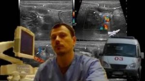 Детское УЗИ кишечника - Острый аппендицит, тифлит