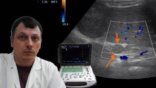 Детское УЗИ брюшной полости - Добавочная селезенка смотреть онлайн