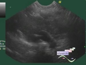 Мини-Лекция: УЗИ вилочковой железы / тимуса - Базовый Уровень. Измерения