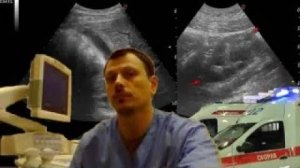 Детское УЗИ брюшной полости - Клинически подозреваемый аппендицит 4