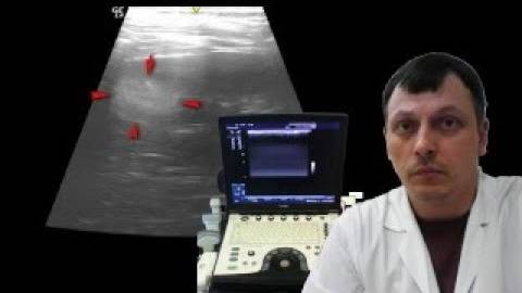 Детское УЗИ почек - Гиперэхогенный сегмент почки смотреть онлайн