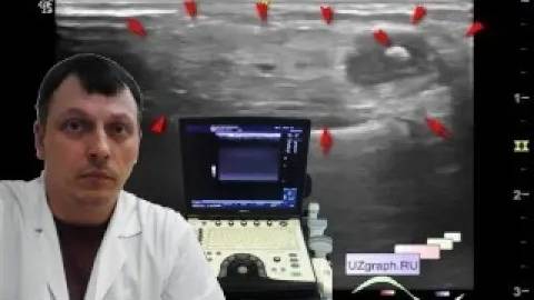 Детское УЗИ мягких тканей - Инфильтрат/ флегмона кисти руки смотреть онлайн