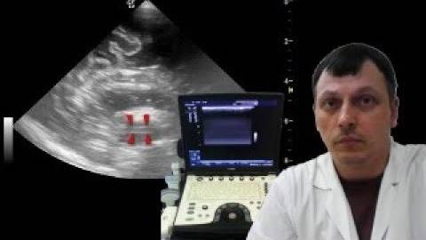 Детская Нейросонография - Аберрация межталамического сращения смотреть онлайн