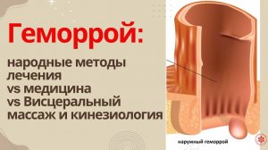 Геморрой: народные методы лечения vs медицина vs  Висцеральный массаж и кинезиология.