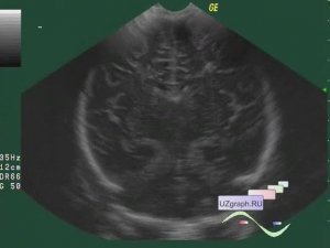 Лекция: Нейросонография (УЗИ головного мозга). Базовый уровень.