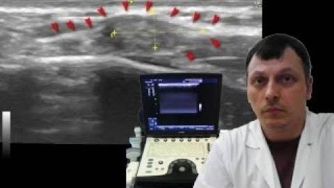 Детское УЗИ мягких тканей - Подкожное образование над грудиной смотреть онлайн