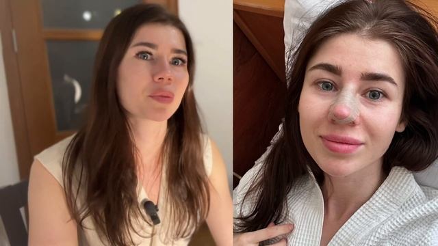 Горбинка на носу снова после ринопластики смотреть онлайн