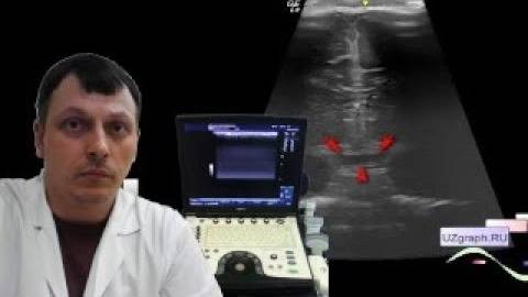 Детское УЗИ головного мозга (нейросонография) - Супраселлярное образование смотреть онлайн