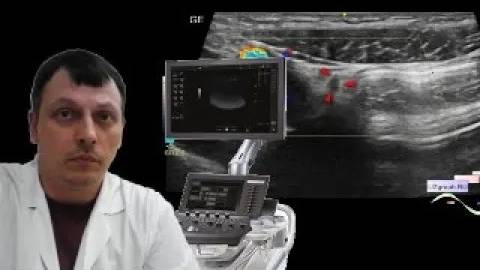 Детское УЗИ брюшной полости - Инфицированная медиальная пупочная связка смотреть онлайн