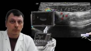 Детское УЗИ брюшной полости - Инфицированная медиальная пупочная связка