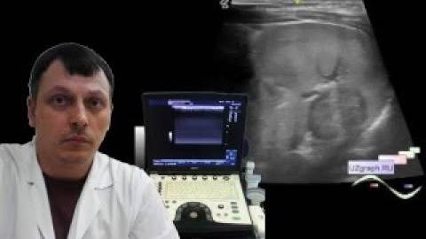 Детское УЗИ брюшной полости - Диффузные изменения селезенки, симптом зебры смотреть онлайн