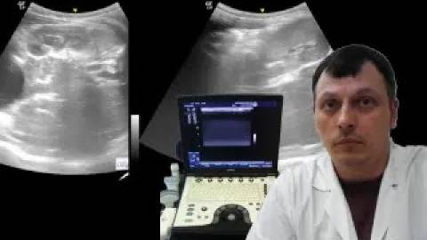 Детское УЗИ брюшной полости - Аномалии положения селезенки и левой почки смотреть онлайн