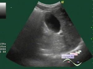 Лекция: УЗИ брюшной полости. Базовый уровень