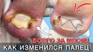 шокирующий случай врастания ногтей