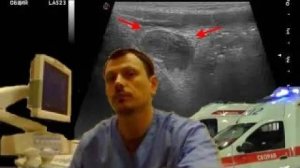 Детское УЗИ кишечника - Острый аппендицит / периаппендикулярный инфильтрат