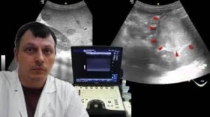 Детское УЗИ брюшной полости - Образование в проекции хвоста поджелудочной железы плюс