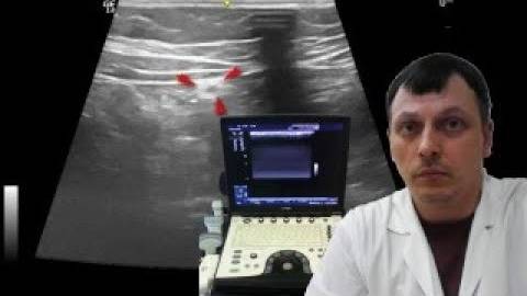 Детское УЗИ брюшной полости - Подозрительная круглая связка печени смотреть онлайн