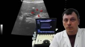 Детское УЗИ брюшной полости - Образование в проекции тела поджелудочной железы