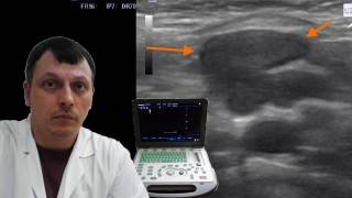 Детское УЗИ брюшной полости - Мезаденит смотреть онлайн