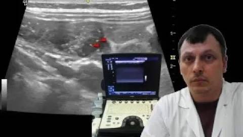 Детское УЗИ брюшной полости (кишечника) - Некротический энтероколит смотреть онлайн