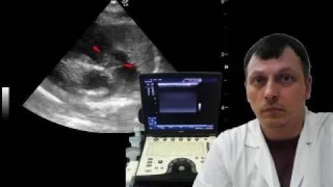 Детское УЗИ сердца (эхокардиография) - Флотирующая добавочная ткань легочного клапана смотреть онлайн