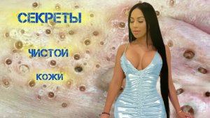 Самые Жирные и Вонючие прыщи Угри и Акне !