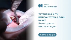Установка 5-ти имплантатов в один визит. Антистресс-имплантация