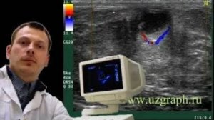Детское УЗИ молочных желез - Киста с воспалением (подострый мастит)