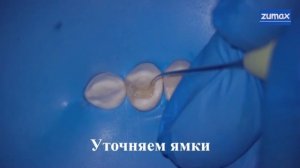 Фрагменты этапов реставрации премоляра верхней челюсти в концепции AVS