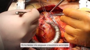 Коронарное шунтиование