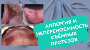 Как проявляется и что делать при аллергии на съемные зубные протезы?