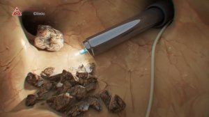 Удаление любых камней в почках, лечение мочекаменной болезни