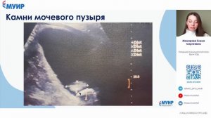 Камни мочевого пузыря в УЗИ-диагностике #медицина #врач #ультразвуковаядиагностика #узи #здоровье