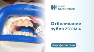 Отбеливание зубов ZOOM 4 в Belgravia Dental Studio