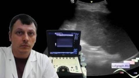 Детское УЗИ брюшной полости - Цирроз печени и утолщенный сальник смотреть онлайн