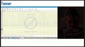 Учим проводить ЭЭГ при эпилепсии #медицина #врач #невролог #эпилепсия #доктор #здоровье #ээг