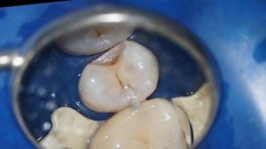 Скрытый кариес: то, чего не видно на глаз #скрытыйкариес#доипосле #dentistry#dentalcase#restoration
