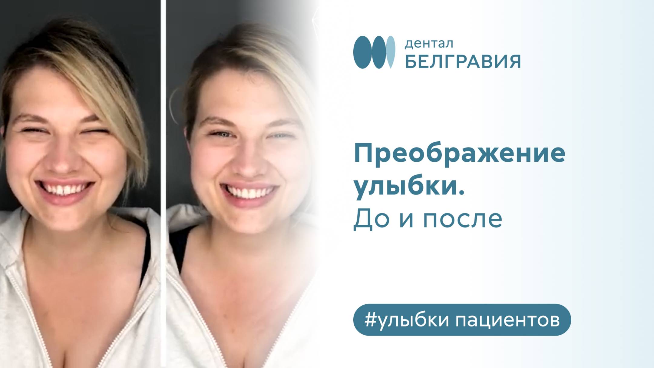 Преображение улыбки. До и после
