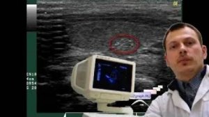 Детское УЗИ щитовидной железы - Область щитовидной железы с гиперэхогенными точечными включениями