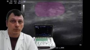 Детское УЗИ молочных желез - Изолированное телархе у грудничка