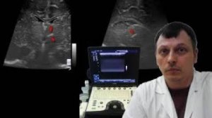 Детское УЗИ головного мозга (нейросонография) -  Гиперэхогенное включение в таламусе