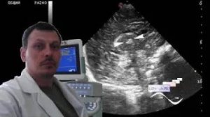 Нейросонография - Образование левого таламуса