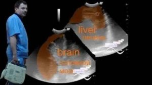 Нейросонография - Неонатальный геморрагический синдром