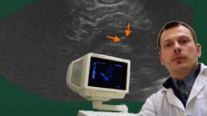 Нейросонография - Cубэпендимальная киста с пульсацией