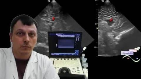 Детское УЗИ головного мозга (нейросонография) - Хорда бокового желудочка головного мозга смотреть онлайн