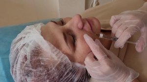 Носогубные складки - коррекция филлером