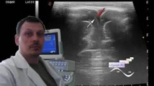 Детское УЗИ головного мозга (нейросонография) - Субдуральное кровоизлияние