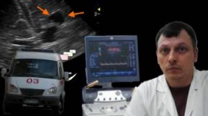 Нейросонография - Перивентрикулярная лейкомаляция